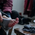Engelure au pied : traitement et signes visibles